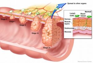 colon_cancer_stages